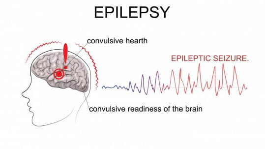 Epileptic-Seizure